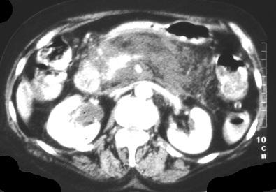 Význam CT zjistit závažnost zánětlivého procesu diagnostikovat komplikace AP (časná detekce a kvantifikace