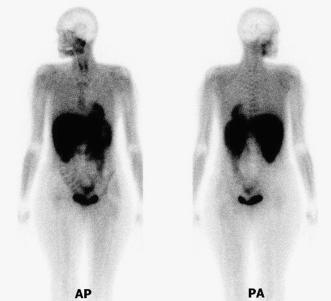 1c Tab. 1. Prediktivní cena bazální 99m Tc-MIBI scintigrafie u pacientû po intenzivní chemoterapii (n = 29