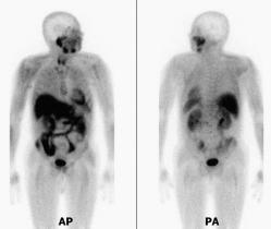 klinického stavu nemocn ch po chemoterapii. Jsme si vûdomi nûkter ch limitací této pfiedbûïné studie.