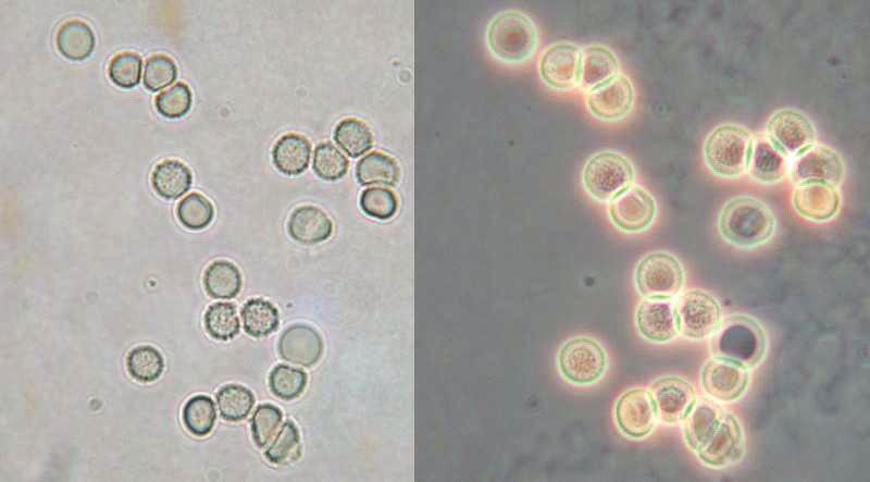 1.) Erytrocyty - zobrazení drobné útvary s projasn ním uprost ed - diagnóza hematurie