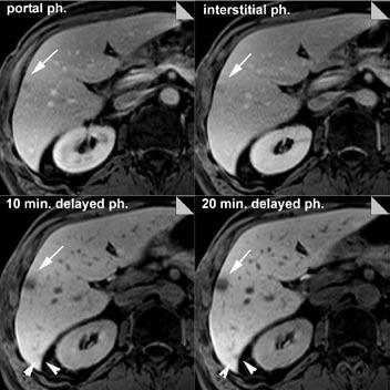 vyšetření Metastáza vykazuje dobře vyjádřený pomalý nástup intenzity signálu v arteriální a portální fázi a snižuje intenzitu ve fázi pozdní. Fig. 1.