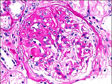 Fokálně segmentální glomeruloskleróza (FSGS) SYNONYMA: fokálně segmenální skleróza