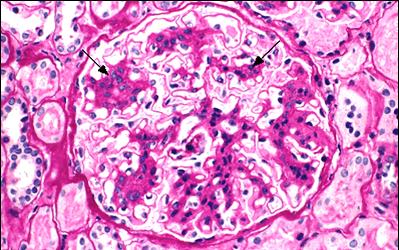 Imunoglobulin A nefropatie SYNONYMA:IgA nefropatie, Bergerova choroba EPIDEMIOLOGIE: nejčastější primární glomerulonefritida na světě