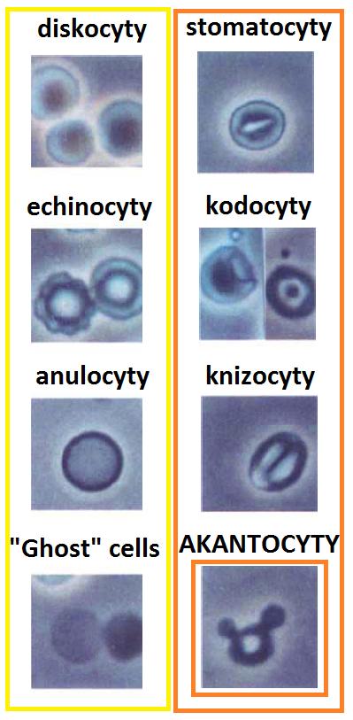 Vyšetření erytrocytů ve fázovém kontrastu světelného mikroskopu Subjektivní hodnocení, mezilaboratorní srovnatelnost, velká šedá zóna Kvalita moči!