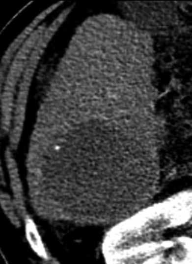 zcela nekrotické na CT (D). Pacient zařazen na čekací listinu, transplantován v lednu 20