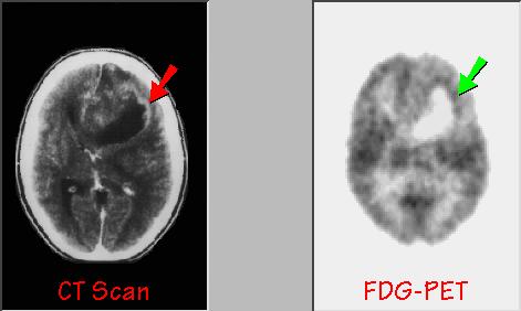 Nukleární medicína Nádor mozku -