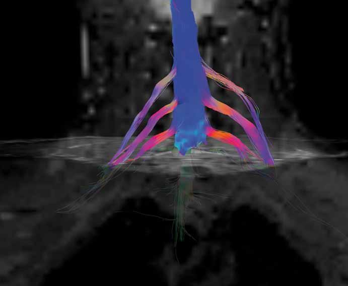 Obr. 3. MR traktografie oboustranného brachiálního plexu u zdravého dobrovolníka (žena, 24 let). Fig. 3. MR tractography of the bilateral brachial plexi in a healthy volunteer (female, 24 years). Obr.