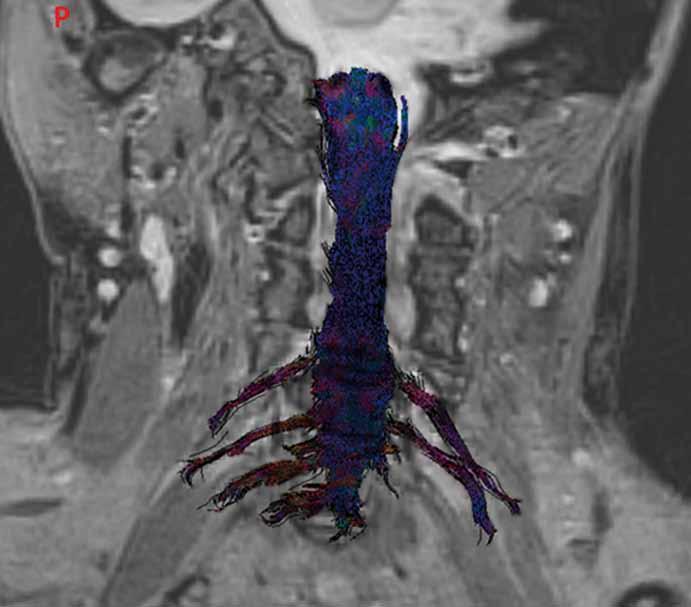 MR tractography of the bilateral brachial plexi following injury showing the missing signal of the left C7 and C8 spinal roots corresponding to avulsion (female, 33 years).