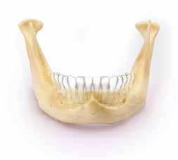 Důsledkem ztráty zubů je postupné ubývání čelistní kosti.