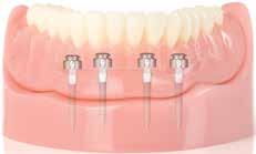Stabilizace snímatelné zubní náhrady pomocí miniimplantátů C-TECH Implant Výhody Dlouhodobá stabilizace náhrady - žádné posouvání ani sklouzávání náhrady Minimálně invazivní přístup - ve velké