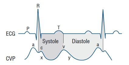 2.4 Křivka CVP Obrázek 5 Korelace CVP křivky s EKG (Reems a Aumann) Jelikož hodnoty centrálního venózního tlaku jsou daleko nižší než hodnoty arteriálního tlaku, také křivky CVP jsou hůře analyzovány