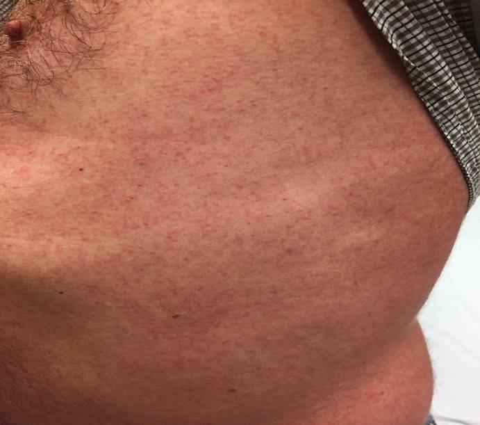 Klinický obraz Infekčnost: 73% (95% CI 68-77) Symptomatický attack rate mezi infikovanými 18% (CI 10-27) Postiženy všechny věkové skupiny Dospělí častěji vyhledávají lékařskou péči Příznaky zpravidla