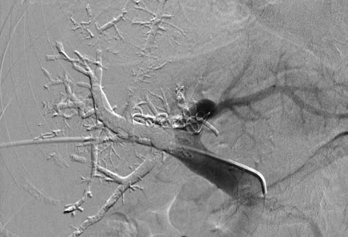 Hereditárny Léčba jaterních angioedém metastáz ako kolorektálního príčina bolestí karcinomu brucha Obr. 1. Portální venózní embolizace. Fig. 1. Portal venous embolisation.