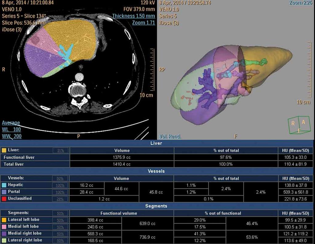 pacienty resekabilní při použití rozšířeného postupu vícedobé resekce, liver first approach (LFA), metody ovlivňující nárůst zbytkového jaterního parenchymu nebo kombinace resekce a radiofrekvenční