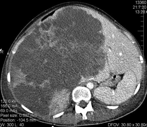 Hereditárny Léčba jaterních angioedém metastáz ako kolorektálního príčina bolestí karcinomu brucha Obr. 3. CT nález neoperabilního nálezu. Fig. 3. CT scan of an inoperable finding. Obr. 4.