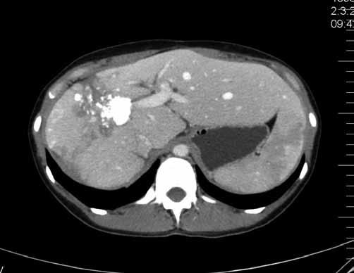 Neoadjuvance u resekabilních nálezů Rozhodnutí o tom, zda provést resekci metastáz v 1. době či nejdříve zahájit chemoterapii, nemusí být při zvážení všech relevantních faktorů jednoduché.