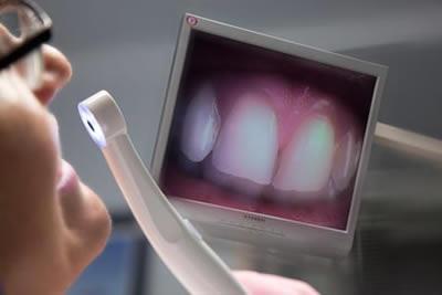 3 INTRAORÁLNÍ KAMERA Intraorální kamera představuje optický zobrazovací systém, který přenáší několikanásobně zvětšený obraz dutiny ústní přímo na LCD obrazovku, umístěnou na stomatologickém křesle.