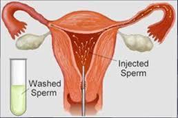 IUI IntraUterine Insemination zavedení opakovaně promytých a seminální plasmy