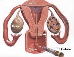 děložní provádí se v případě, že spermiogram vykazuje patologické hodnoty nebo