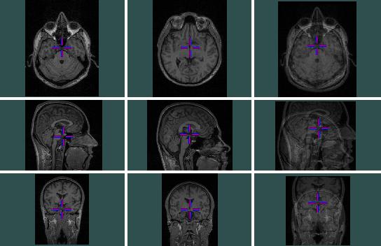 Morfometrie u první epizody schizofrenie CÍL: Nelézt v mozku místa se statisticky významnými anatomickými rozdíly mezi skupinou pacientů postižených první epizodou schizofrenie a skupinou zdravých