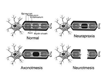 Neurotmeze U neurotmeze dochází jak k přerušení axonu, tak i k poškození jeho obalů.