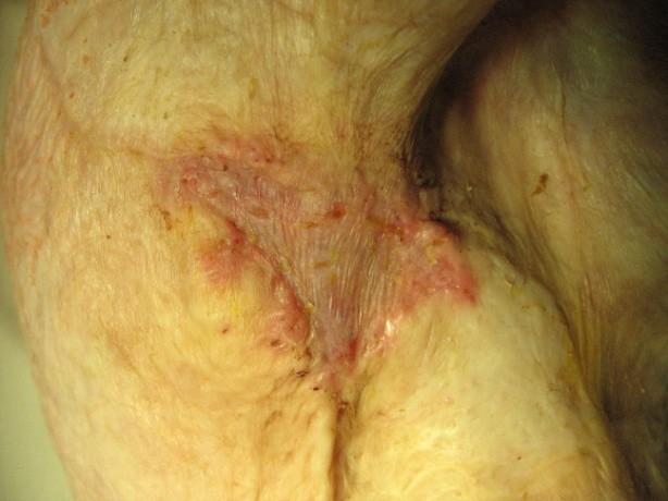 Po přegranulování spodiny defektu 8. den přistupujeme ke kompozitní transplantaci.