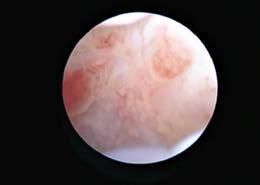 CHONDROMATÓZA Metaplasticky postiženou tkání v případě chondromatózy je synoviální membrána, tj. tkáň, která vystýlá většinu vnitřního povrchu kloubu. Nahrazována je zralou hyalinní chrupavkou.