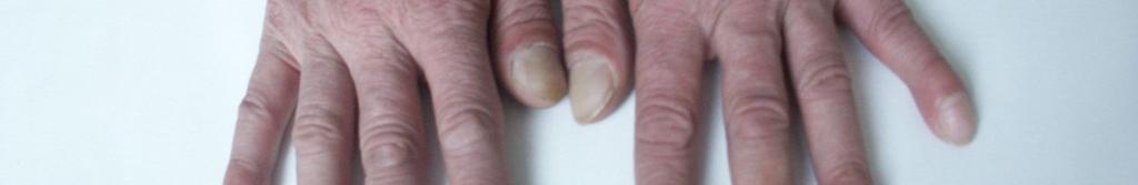 hepatitidy C.