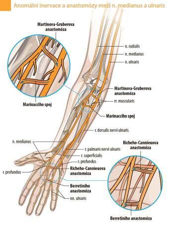 superficiální terminální větev větev k hypothenaru 4 hluboká terminální větev 2 os pisiforme n. ulnaris 3 os hamatum 1 Guyonův kanál Obr. 4. Průběh n. ulnaris v oblasti zápěstí a ruky [1]. Fig. 4. The course of the ulnar nerve in the region of the wrist and hand [1].
