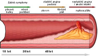 Obrázek 1: Vývoj aterosklerotických změn (převzato: http://www.