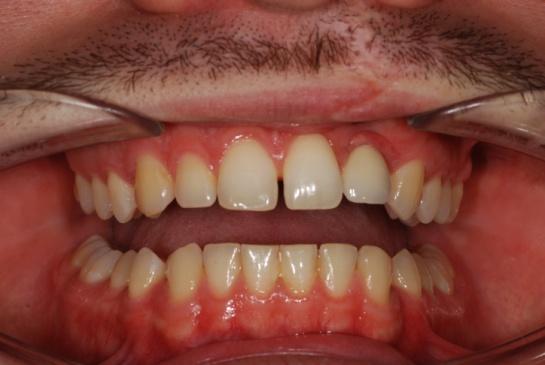 Volba pro implantát byla z estetického i funkčního důvodu. Tyto zákroky už se u takových to pacientů běžně provádějí a není to žádný experiment.