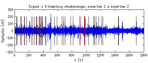 Obr. 8.1: Ukázka signálu s K-komplexy označenými expertem 1 a expertem 2 Z výše uvedené tabulky 8.