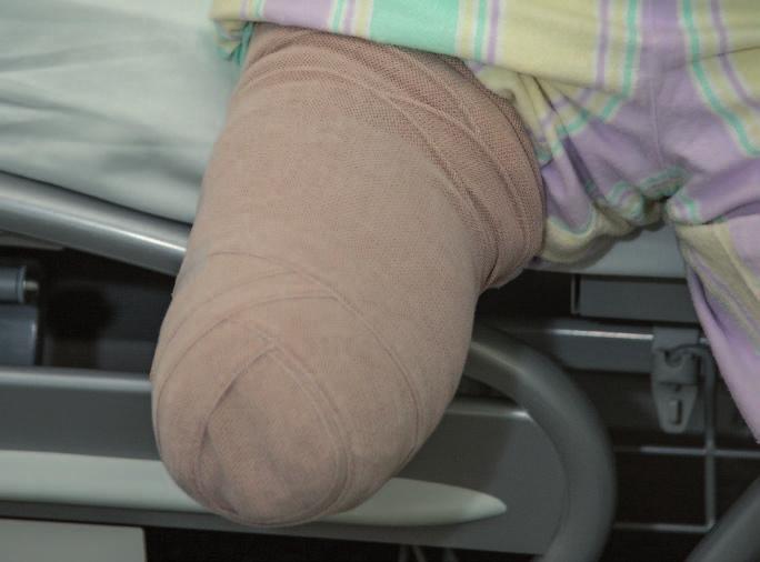 Správné bandážování pahýlu Bandážování pahýlu je vždy velmi individuální. Záleží na zkušenostech fyzioterapeuta či sestry a požadované funkci bandážování.