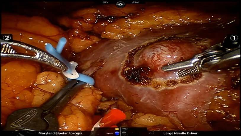 Resection line of a kidney tumour (a), the hypofluorescent tumorous tissue after the application of ICG (b) optimalizován k lokalizaci sentinelové lymfatické uzliny v průběhu pánevní lymfadenektomie