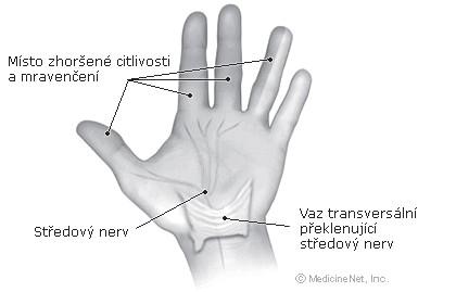 Raynaudův syndrom úzce souvisí nízkým krevním tlakem (prokrvením) končetin. Vyznačuje se záchvatovými poruchami prokrvení prstů a objevuje se hlavně u mladých žen.