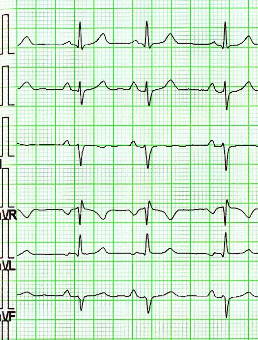 12-svodové EKG EKG sinusový sinusový rytmus I V1 II