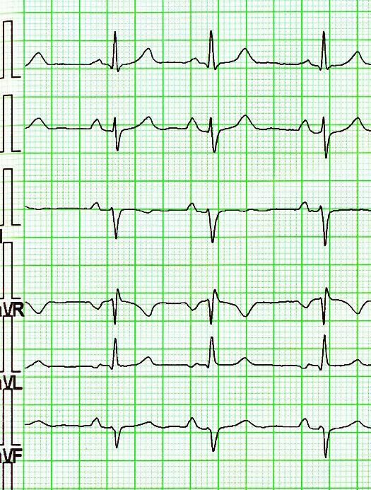 12-svodové EKG EKG sinusový sinusový rytmus I V1 II