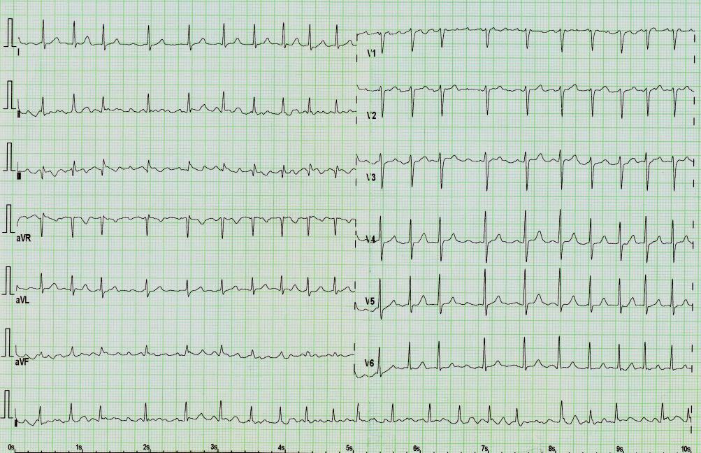 Fibrilace pro srovná srovnání Flutter sí síní Supraventrikulá Supraventrikulární rní extrasystolie Supraventrikulá Supraventrikulární rní