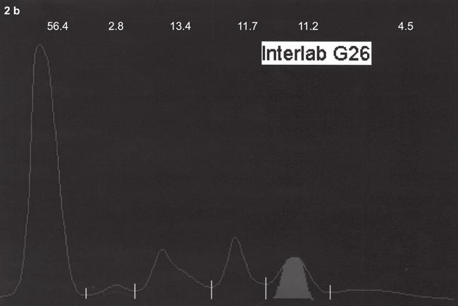 55 g/l (2a), from Interlab G26 6.02 g/l (2b), from Capillarys 5.20 g/l (2c). Immunonephelometric assay showed an IgA concentration 6.42 g/l.