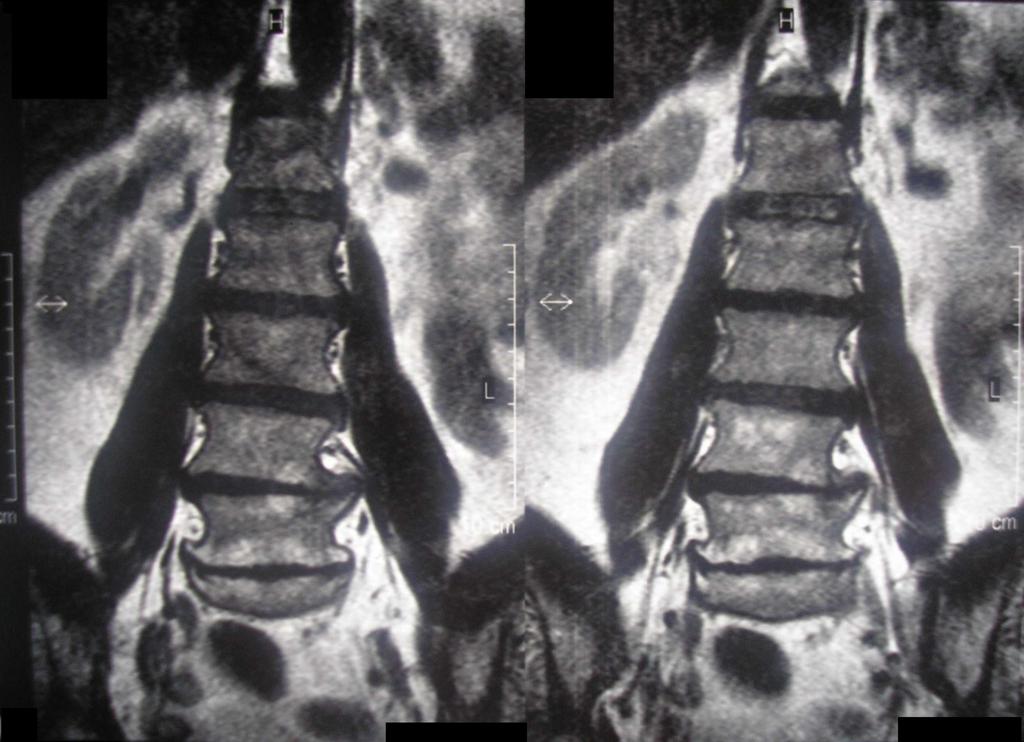 Obr. 68 : Snímek z magnetické rezonance (zdroj: Krajská nemocnice Liberec). Z dodaných snímků je jasně zřetelný kostní výrůstek v oblasti spodní hrany obratlového těla.