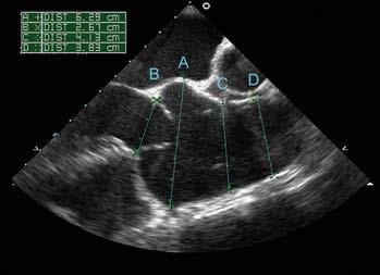 Schéma reimplantace aortální chlopně podle Davida do valsalvovské protézy s předvytvořenými