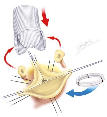 Schéma remodelace aortálního kořene podle Yacouba doplněné implantací expandibilního