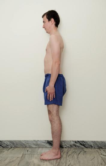 Nemocný AS v anteflexi trupu mírná deformace do extenze U postižení velkých kloubů při