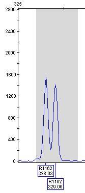 CFTRdele2,3 (21 kb) Fragmenty alety G85 / G85E se nacházejí v exonu 3 a detekce se projeví ve vzorcích nesoucích CFTRdele2,3 (21 kb).