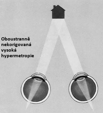 Obr. 4 Rozostřený obraz na obou sítnicích u vysoké hypermetropie [3] 3.