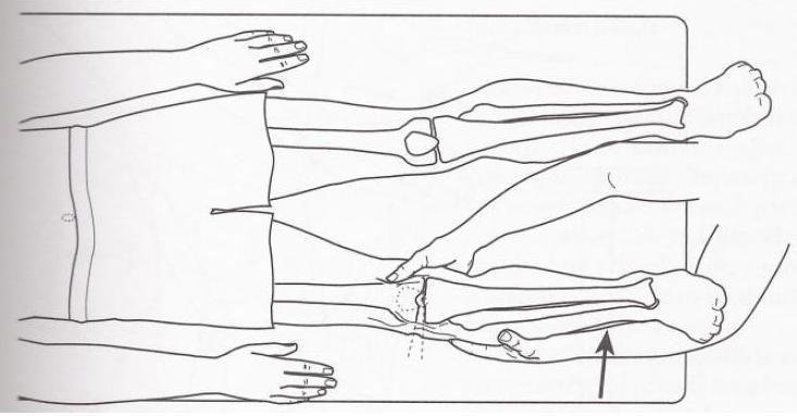 Obrázek15: Pivot shift test (http://orthoteers.blogspot.com/2007/10/knee-pivot-shifttest.
