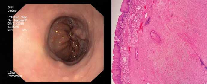 Hereditárny Nekonečná endoskopická angioedém ako cesta príčina aneb bolestí endoskopická brucha chirurgie Nekonečná nový obor?