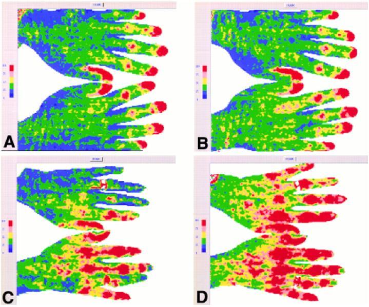Obr. 12 Zobrazení rozvoje Raynaudova fenoménu pomocí Laser Doppler flow imaging. Červená barva odpovídá nejniţší perfuzi, modrá barva nejvyšší perfuzi. 3.
