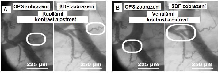 Obr. 19 Princip zaostřování SDF sondy. Převzato a upraveno z Goedhart 2007. Obr. 20 Rozdíly v kvalitě zobrazení kapilár a venul pomocí A- OPS a B- SDF zobrazení. Převzato z Goedhart 2007. 3.5.