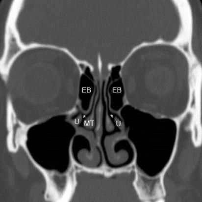 Bulla ethmoidalis http://uwmsk.